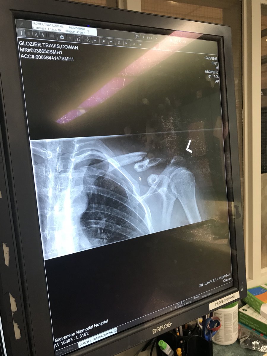 KendallMegan14's tweet photo. All smiles before surgery! Nothing like adding more metal to your left side 😂 #shatteredshoulder #30sproblems https://t.co/TTn2mewo9z