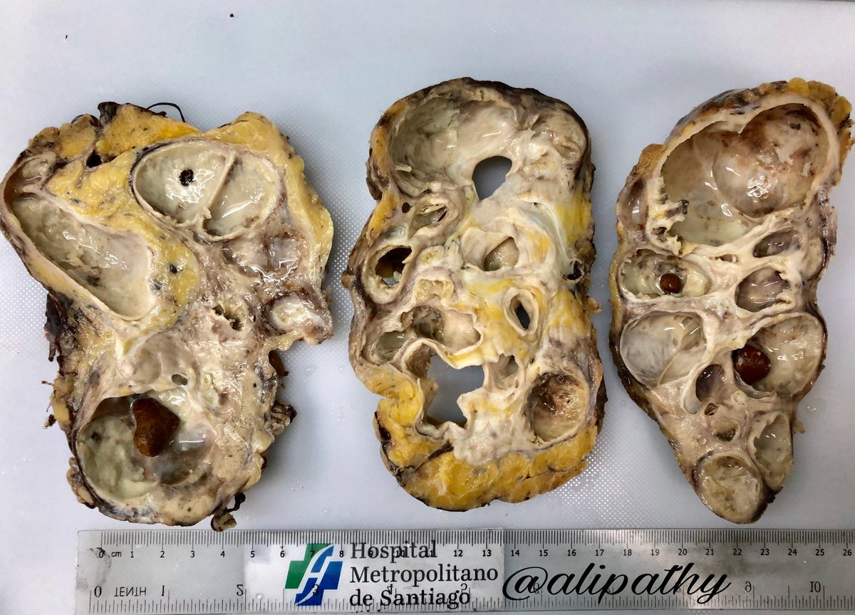 Alipathy's tweet photo. 🔪 #Grossgnosis Chronic &amp; Acute Supurative Pyelonephritis+mark dilated Pyelocaliceal System, hydronephrosis and Lithiasis (EndStageRenalDisease) 745 grs. This is the end (it’s a song from The Doors 2) result of many renal diseases whether they are GN, vascular or CPN #pathology https://t.co/3O1aiEDn4R