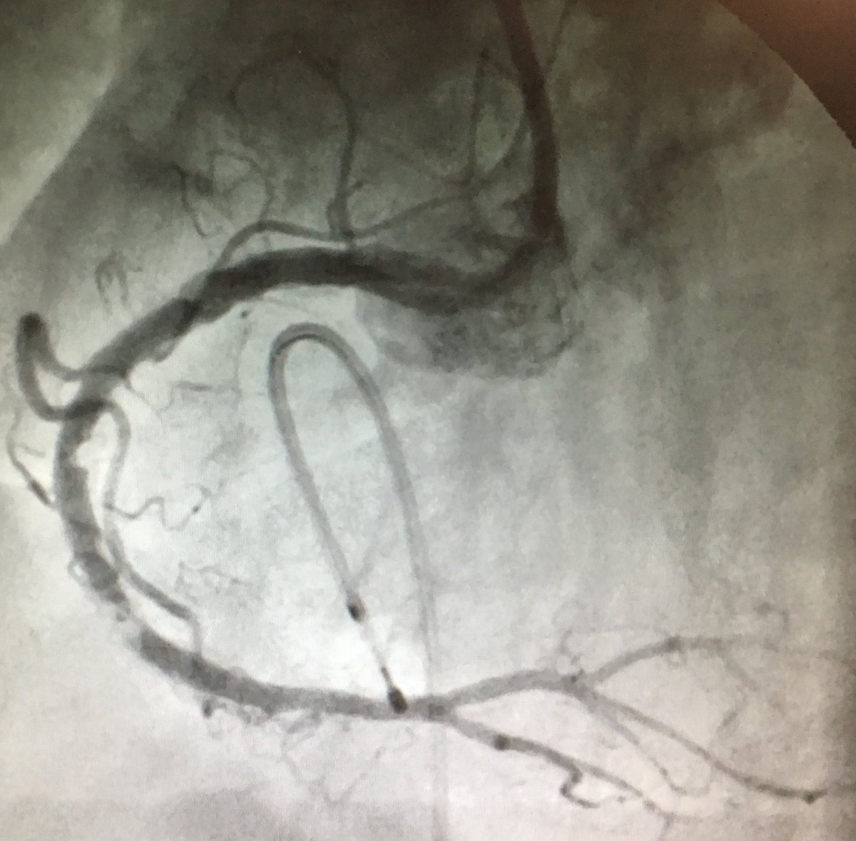 Dr_Connolly's tweet image. Great example of a #rotablation one of my bosses did. 3 rocks of calcium in the RCA smashed into smithereens and then 2 x overlapping DES to proximal and mid vessel #CardioEd