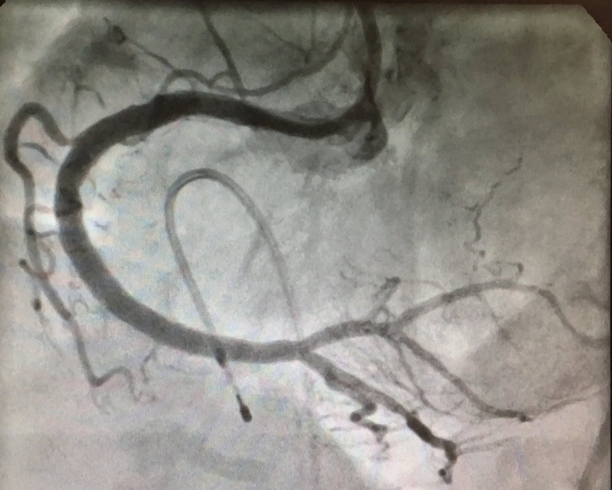 Dr_Connolly's tweet image. Great example of a #rotablation one of my bosses did. 3 rocks of calcium in the RCA smashed into smithereens and then 2 x overlapping DES to proximal and mid vessel #CardioEd