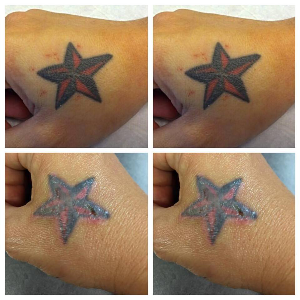 OriginalYouLV's tweet photo. #before and immediately #after a #laser #tattooremoval treatment. https://t.co/1cYZsdxUZB 702-631-5009 Reclaim Your Past Today! #originalyoustories #reclaimyourpast #vegastattooremoval #vegas @yelplv #yelplv #resultsmatter #results #vegasresults #happyskin #byeink #tattoo #ink https://t.co/NlXk11sehE