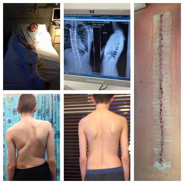 RunningVicci's tweet photo. So 5 years ago today my Conor went in to get his spinal surgery done. Can’t believe where that time has gone. #HappyFiveYears #NewStraightSpine @RNOHnhs @thernohcharity #Stanmore 💙 https://t.co/ZayOAkF7Q7
