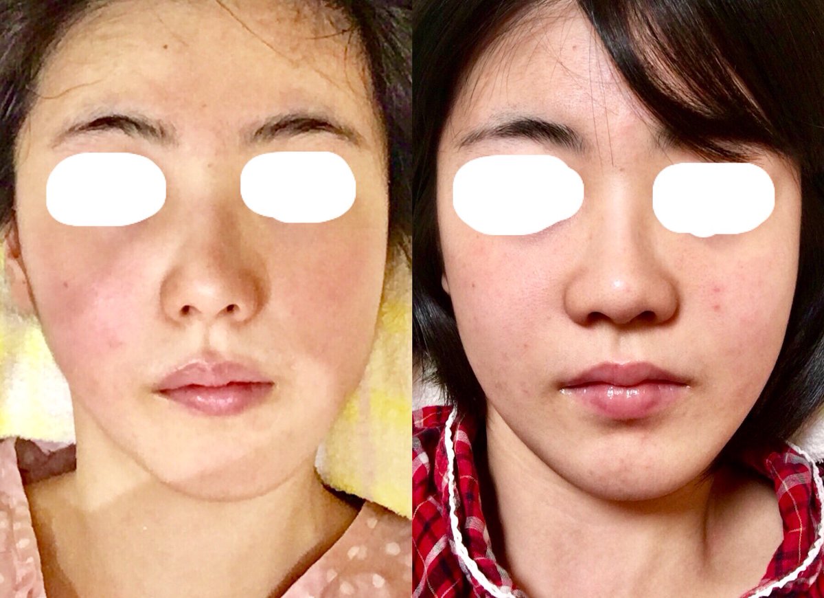 Twitter पर ゆかり 元顎変形症 気まぐれで入院前日と同じ場所 同じアングル を目指して 写真撮ってみました 鼻と肌荒れがすごい 今 ちなみに そもそも左右で骨の大きさが非対称だったため まだ顔は歪んでまして そこはプレート除去時にオトガイ形成します 顎変形 Twitter पर ゆかり 元顎変形症 気まぐれで入院前日と同じ場所 同じアングル を目指して 写真撮ってみました 鼻と肌荒れがすごい 今 ちなみに そもそも左右で骨の大きさが非対称だったため まだ顔は歪んでまして そこはプレート除去時にオトガイ形成します 顎変形