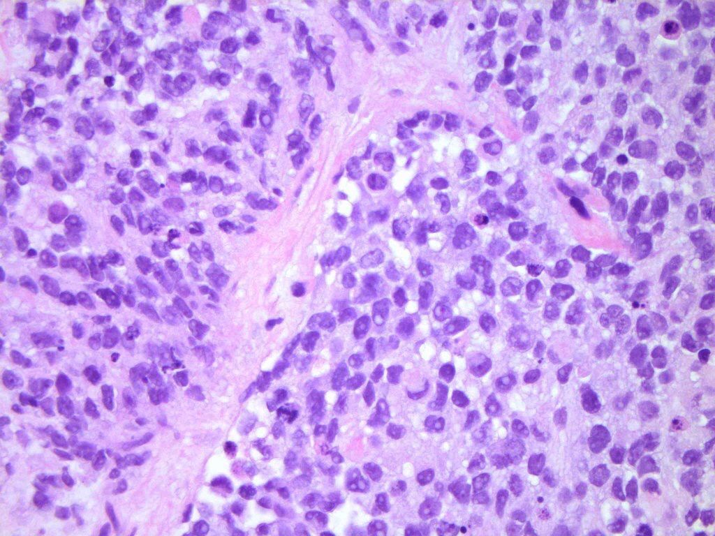 JMGardnerMD's tweet photo. Alveolar rhabdomyosarcoma may lack alveolar spaces. Solid nodules uniform round cells,fibrous septa. DIFFUSE myogenin +. Pics: @histiocytosisX. #pathology #BSTpath #pedipath https://t.co/PO7gsRSo5k