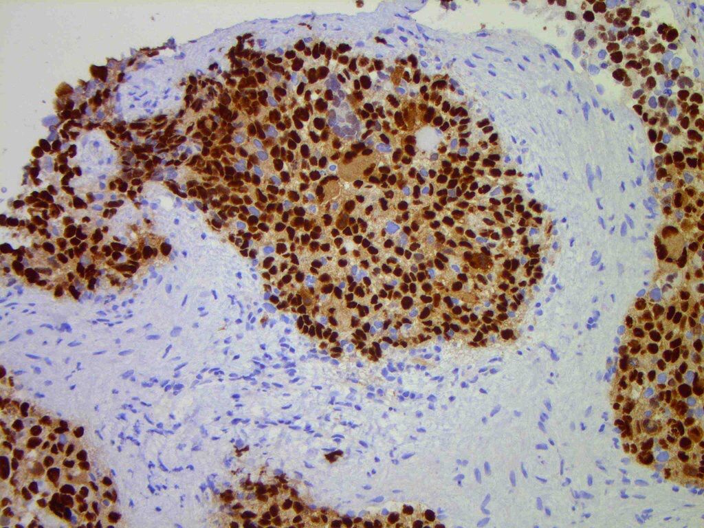 JMGardnerMD's tweet photo. Alveolar rhabdomyosarcoma may lack alveolar spaces. Solid nodules uniform round cells,fibrous septa. DIFFUSE myogenin +. Pics: @histiocytosisX. #pathology #BSTpath #pedipath https://t.co/PO7gsRSo5k