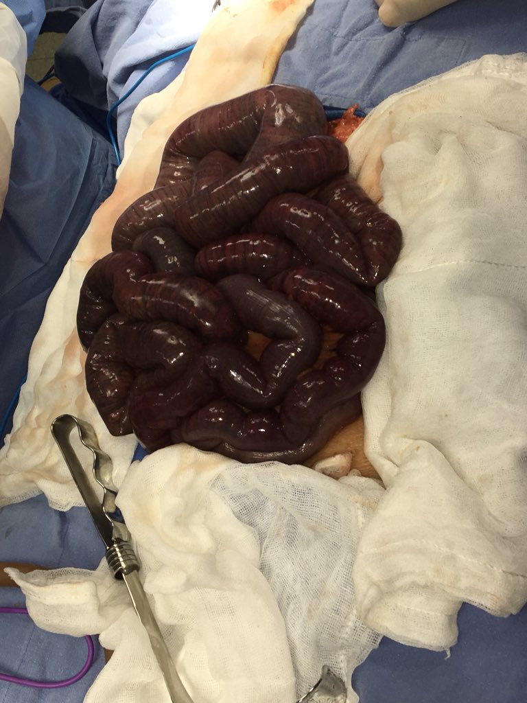 cirujanogastric's tweet photo. 😪 Hallazgo difícil en la Cirugía de urgencia: Isquemia mesentérica aguda arterial masiva #Gastricpost #NecrosisIntestinal #MexicanosCuidandoMexicanos https://t.co/QOwUy3fMPM