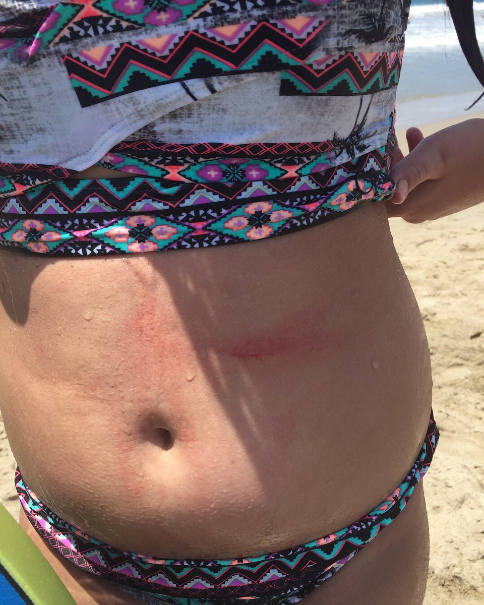 thewavecutter's tweet photo. #DYK our boards are so slick and smooth you donβt need a rash guard to ride?!
ππ»π―β¨
Swipe through to see how the competitors fall shortβ‘οΈ
#wavecutter #norashguardnoproblem #rashguard #bodyboard #bodyboarder #smooth #slick #yew https://t.co/hywLpYfIBt