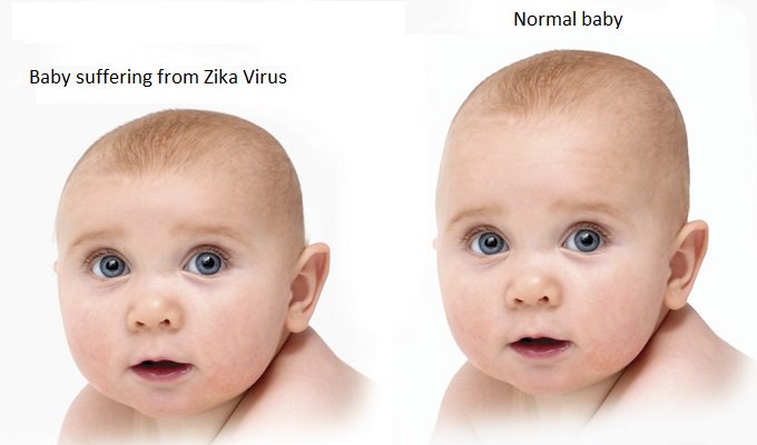 FLHS_marcellac's tweet photo. Zika is a disease caused by Zika virus that's spread through mosquito bites. A pregnant woman already infected with Zika virus can pass the virus to her fetus during the pregnancy or around the time of birth. It can cause microcephaly and other brain malformations in some babies https://t.co/Mgv7RgvE3O