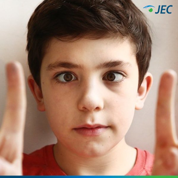 JECEyeHospital's tweet photo. Ciri-ciri mata juling akan tampak bila kedua mata tidak tertuju pada satu objek sehingga satu mata lurus ke depan dan mata lainnya menyimpang dari posisi yang seharusnya. #Strabismus #JEC #MataJuling https://t.co/JarYEwBxqP
