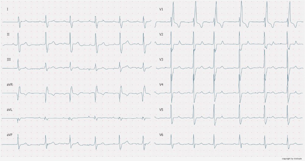 ecgbuddy's tweet photo. Right or left bundle branch block?

#ECG #ecgbuddy #studybuddy #doctopia #ecg #ecginterpretation #ecgreading #ecgcourse #emergencyroom #hospitallife #medicalstudent #medschool #medicallife #ERlife #doctorslife https://t.co/JtqCbiUD8w