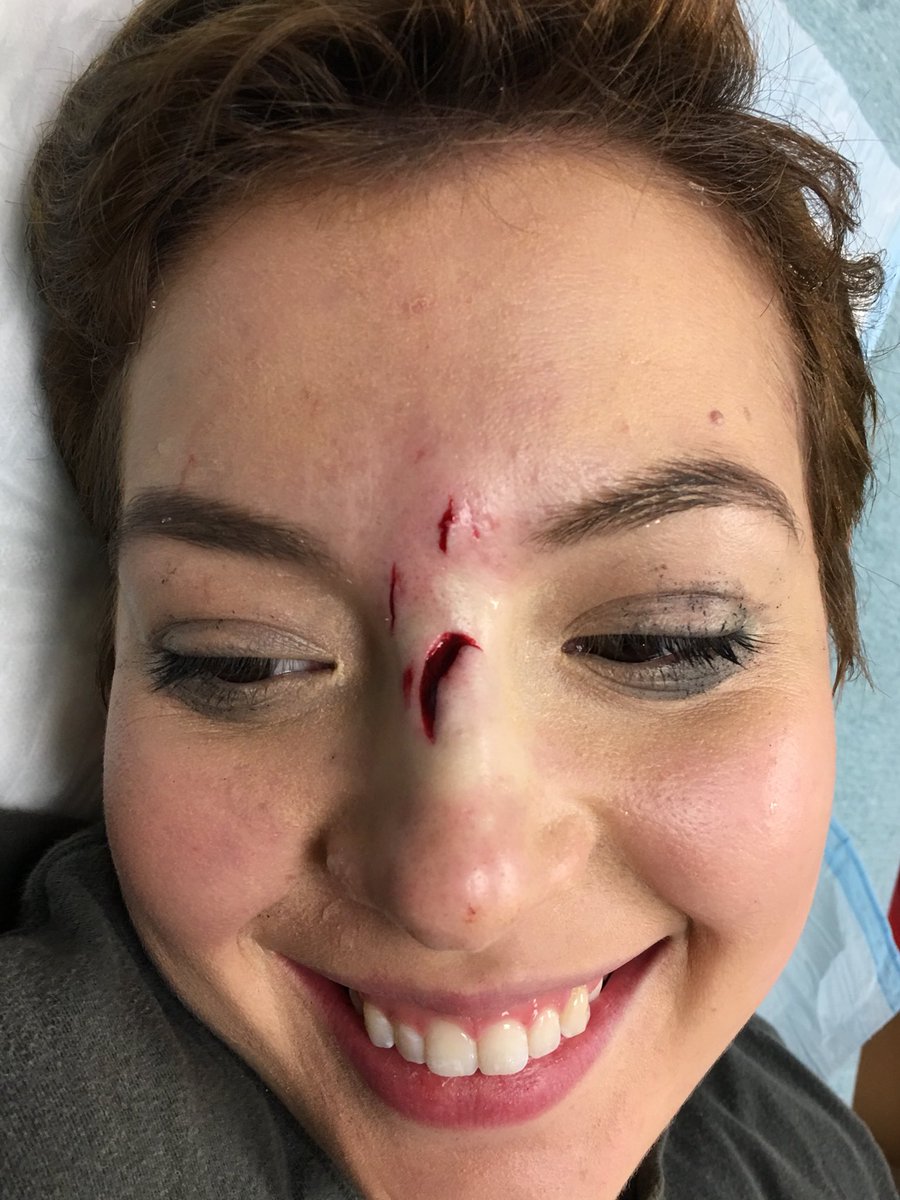 ReeceeGilbert's tweet photo. Hey internet wanna see some dog bite pics here ya go https://t.co/gtvOfd5xiB
