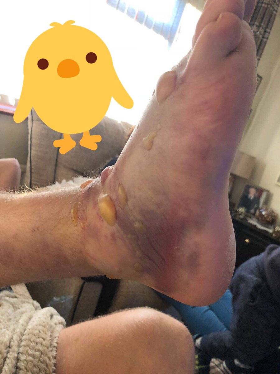 Shreddedducks7s's tweet photo. @Beer_Lewis going under the knife tomorrow. Hope everything goes well and your foot looks a bit less like @WOW7S team roster. #moredustyducks #anotherone #ibiza #quack https://t.co/2DEh4kLkBE