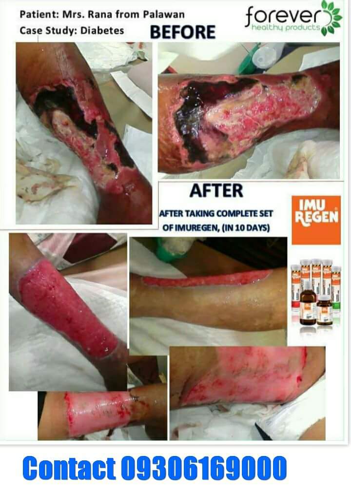 "GUMINHAWA,GUMALING, NAKA RECOVER dahil sa pag-inom ng IMUREGEN
● Cancer Tumor &amp; Growth
● Diabetes type 2
● Myoma
● Bronchial Problem 
● Prostate Problem 
● High Cholesterol 
● Alzheimer's 
● Thyroid Problem 
● Kidney and Liver
● Ovarian Problems 
+ (UTI)