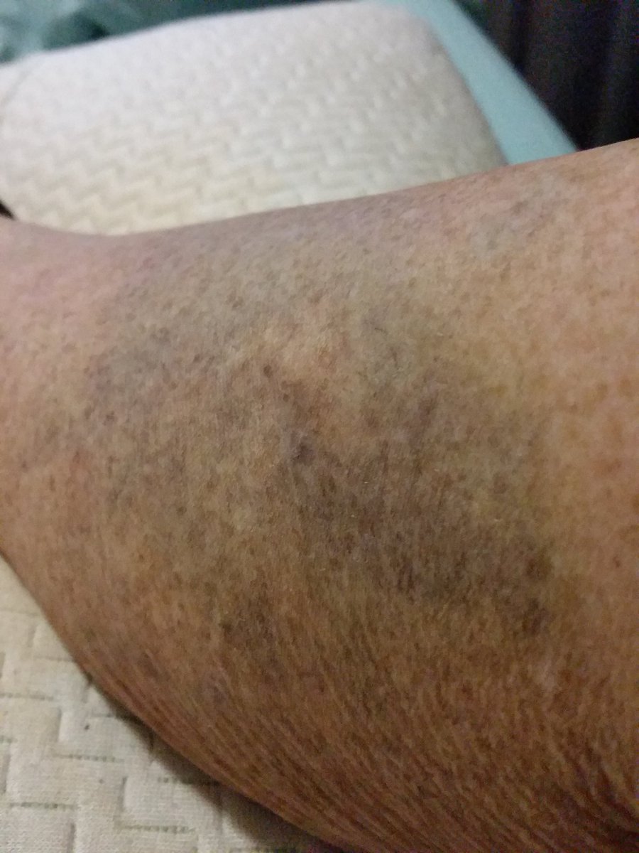 My leg varicose  veins