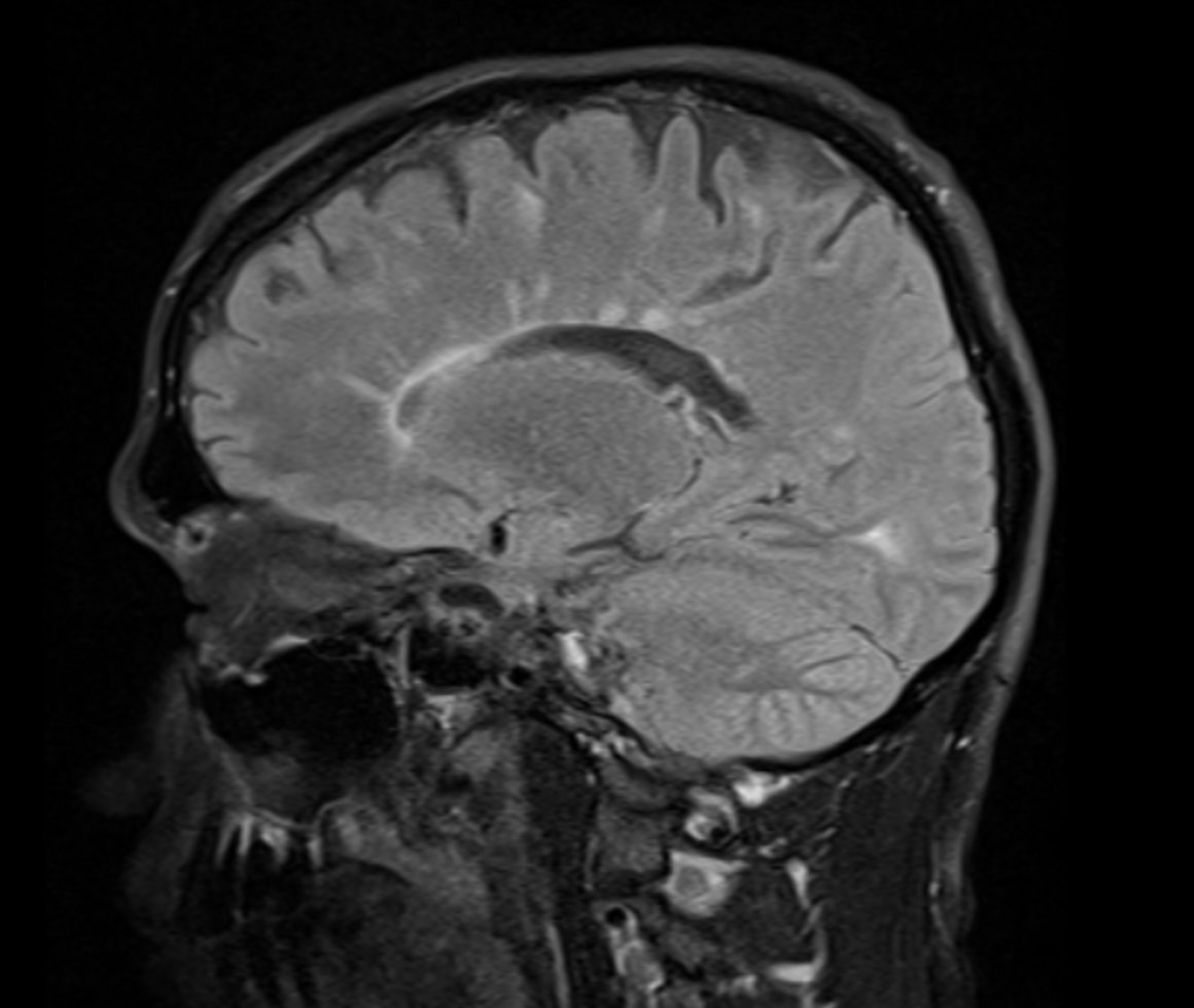 Rad_Bits's tweet photo. Quiz211: Finding? Diagnosis?
#طلاب_الطب
#kku_med #uqumed #UQUMed35 #kau_med #bu_medicine #foamed #foamrad #radres #medicnina #radiologie @medicine_bu @guide1_me #med15 #med16 #med17 #med18 #med19 #med14 #med13 #imed14 #imed16 #med20 #usmle #usmle_prep #usmle1 #usmle2 #medical https://t.co/5bFpEKjHpM