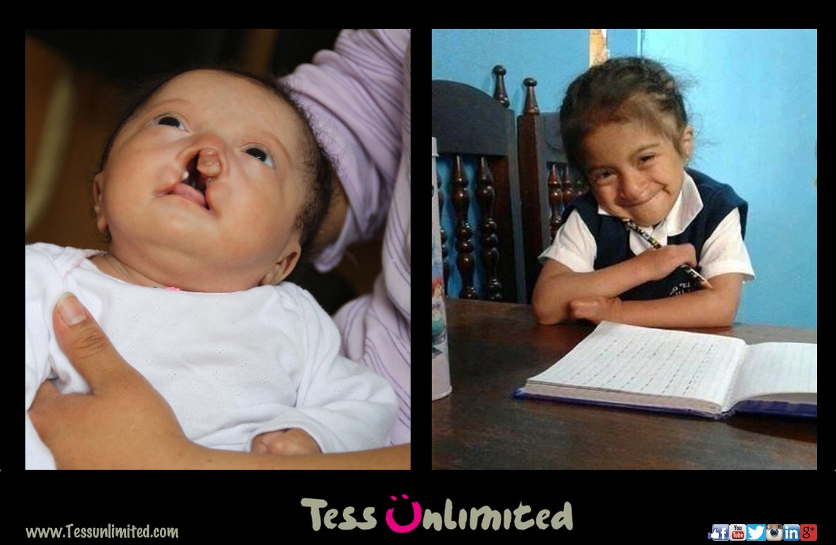 TessUnlimited's tweet photo. We did surgery on Zureiymi 5 years ago. Malourished with a severe wide cleft and 'lobster hands'. She went from our milkproject until speech therapy now she overcame all adversities and now is going to school.
#goingfullcircle #tessunlimited #weloveresults #untilthejobisdone https://t.co/4q42RrbNP1