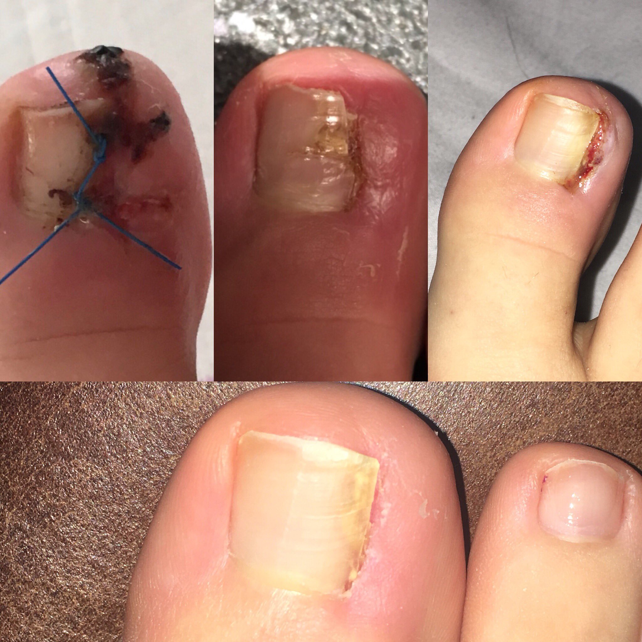 Do not pick at the skin around the nail. This can cause more damage and  increase the chance of infection. SEO Title: 