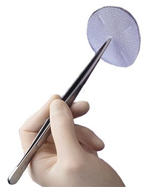 HerniaMeshHelp's tweet image. #Herniamesh litigation mounts hubs.ly/H09WJ020 by @nhbr #mesh #hernia #masstort