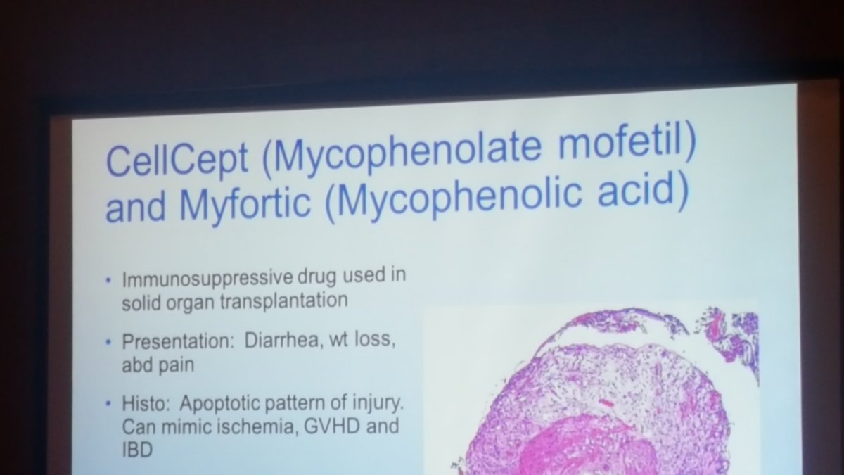 Sanjay Kakar (@sankakar) on Twitter photo More pearls from Dr. Dora Lam-Himlin in an update in Utah: not all apoptosis is GVHD. Remember CMV, drugs like mycophenolate, colchicine, chemotherapeutic drugs <a href="/DoraGIPath/">Dora Lam-Himlin, MD</a> <a href="/LiverPath_HPHS/">Hans Popper Hepatopathology Society</a> <a href="/ARUPLabs/">ARUP Laboratories</a> More pearls from Dr. Dora Lam-Himlin in an update in Utah: not all apoptosis is GVHD. Remember CMV, drugs like mycophenolate, colchicine, chemotherapeutic drugs <a href="/DoraGIPath/">Dora Lam-Himlin, MD</a> <a href="/LiverPath_HPHS/">Hans Popper Hepatopathology Society</a> <a href="/ARUPLabs/">ARUP Laboratories</a>