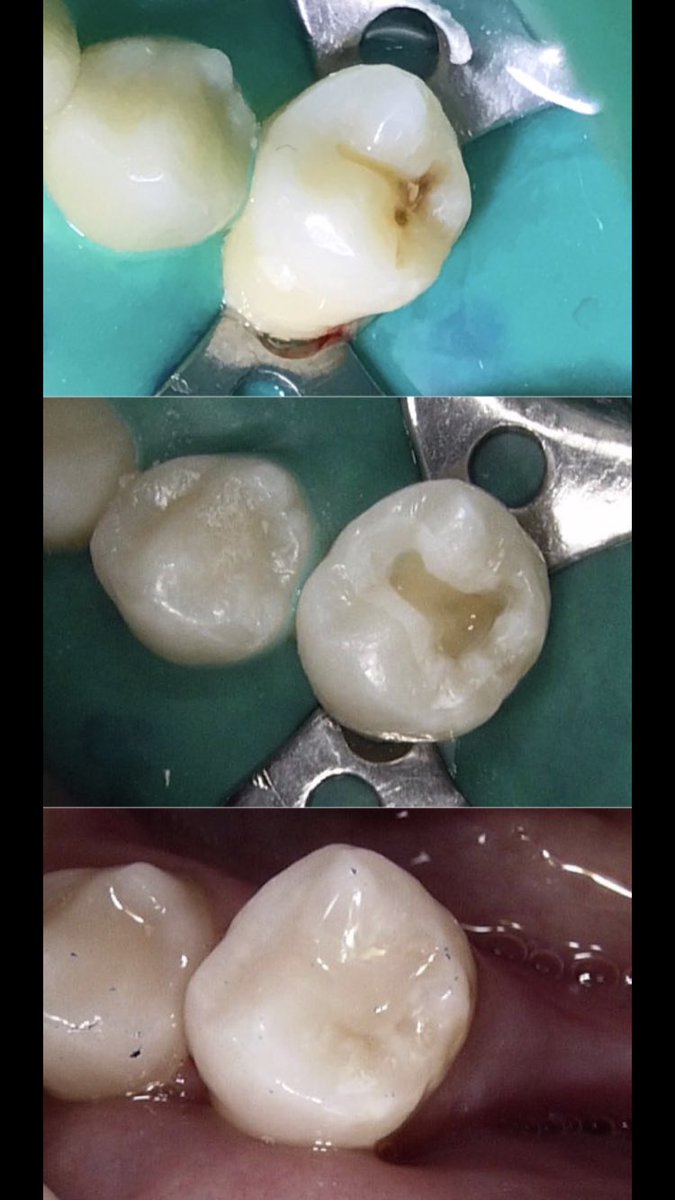 MahaAlSadhan's tweet photo. #35 Class I composite restoration ✨#dent435 #RDS313 https://t.co/o9iQi9T8s3