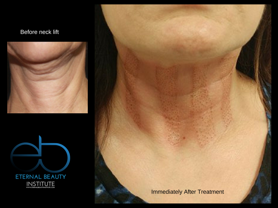 plasmaliftca's tweet photo. Take care of that unwanted saggy skin! PlasmaLift not only diminishes wrinkles and fine lines created over time, but also great for excess or loose skin! Become a Certified PlasmaLift Technician, call us today at 1.866.330.9490. #Plasmalift #PlasmaSoftSurgeryCanada https://t.co/2HmBW8bSv8
