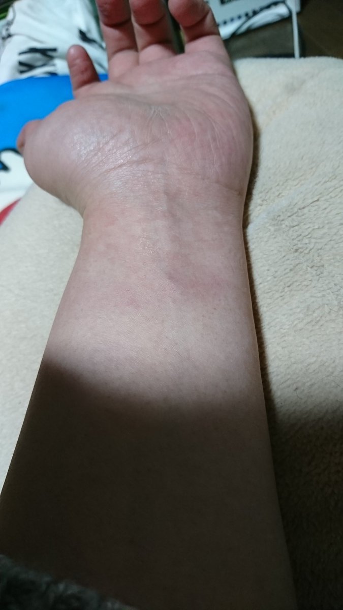 まりちあま チーム桂田 Ar Twitter 原宿さん まり手が痛いだよ 昨日ガンガンやられたときの 痣になって手首痛いだよ