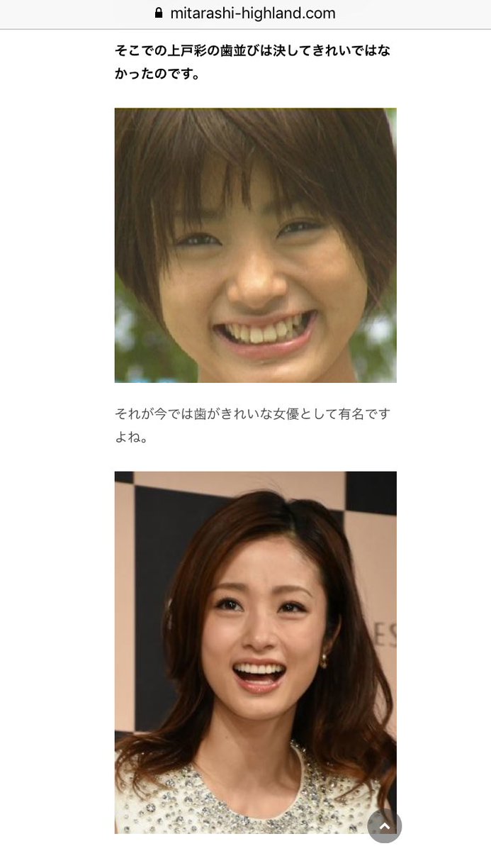 うゆちゃん 矯正して歯並びは綺麗になったけど 前歯が大きくてずっと気にしてる 調べてたら上戸彩さんの過去写真と全く同じ歯でびっくりした 笑 前歯4本だけオールセラミックにしたい T Co Yfkwavdzgo Twitter