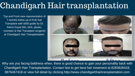 CHD Hair Transplantation (@chandigarhhair) / Twitter CHD Hair Transplantation (@chandigarhhair) / Twitter