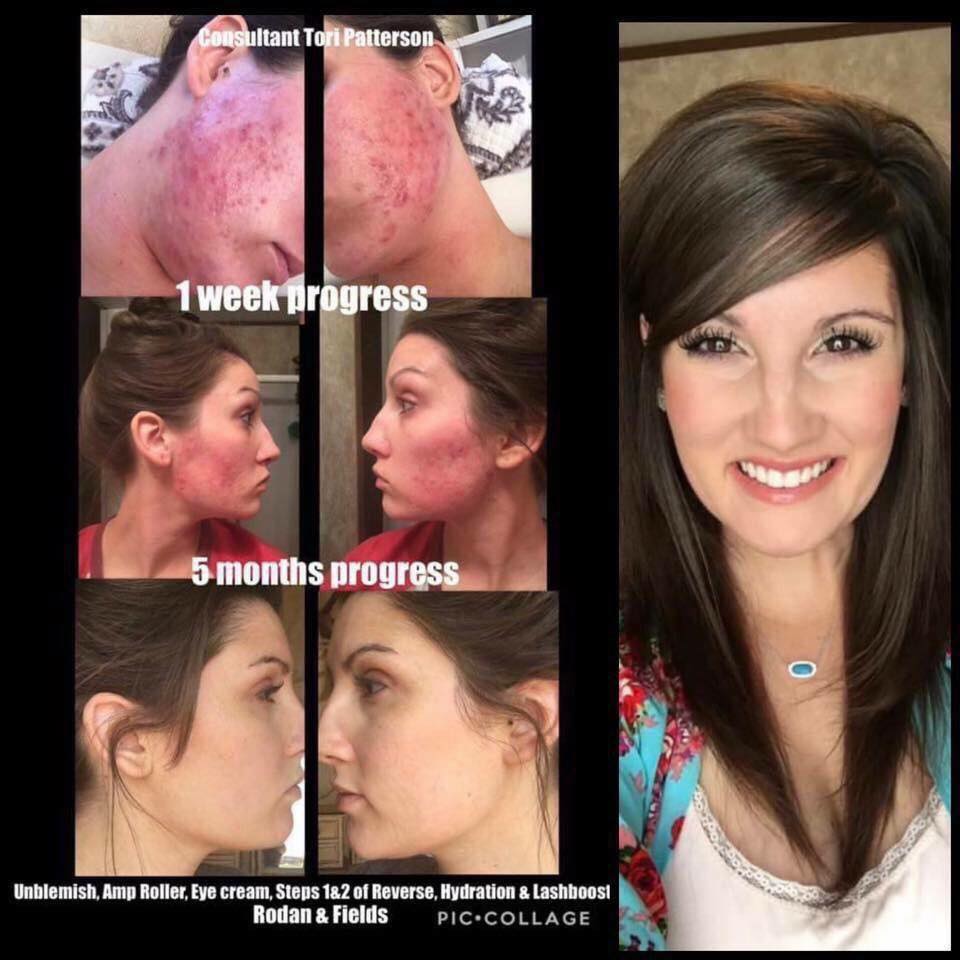 Rodanrodannadan's tweet photo. @ilovepuljujarvi Girl, we have the products to get you on the road to better skin!
Come with 60 day money back guarantee. 
Unblemish has been a game changer for so many!!
I'd love to help you out!
#acne #acneregimen #acnesucks #skin #skincare #beauty #accutane https://t.co/lEiuyt5WW1