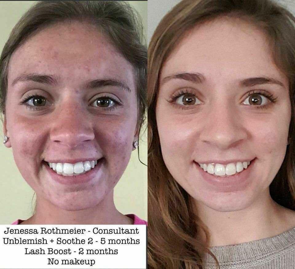 Rodanrodannadan's tweet photo. @eatyurcheckers Girl, we have the products to get you on the road to better skin!
Come with 60 day money back guarantee. 
Unblemish has been a game changer for so many!!
I'd love to help you out! https://t.co/oeBTf4NiIp