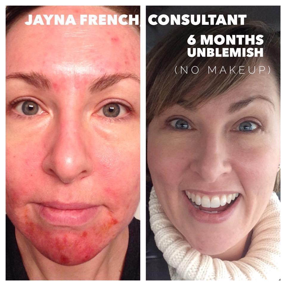 Rodanrodannadan's tweet photo. @eatyurcheckers Girl, we have the products to get you on the road to better skin!
Come with 60 day money back guarantee. 
Unblemish has been a game changer for so many!!
I'd love to help you out! https://t.co/oeBTf4NiIp