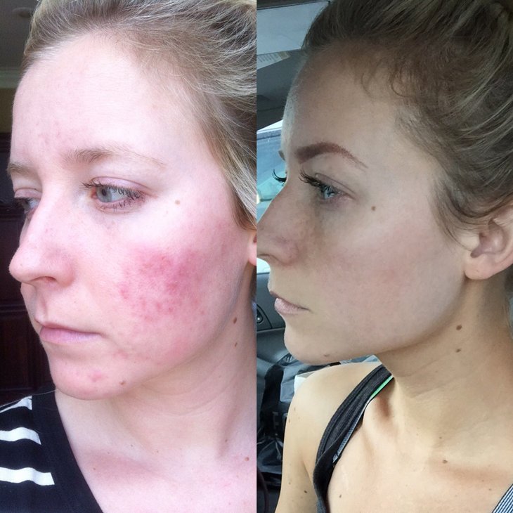 Rodanrodannadan's tweet photo. @kinseyj25 Girl, we have the products to get you on the road to better skin!
Come with 60 day money back guarantee. 
Unblemish has been a game changer for so many!!
I'd love to help you out! https://t.co/W0L2sqAWJi