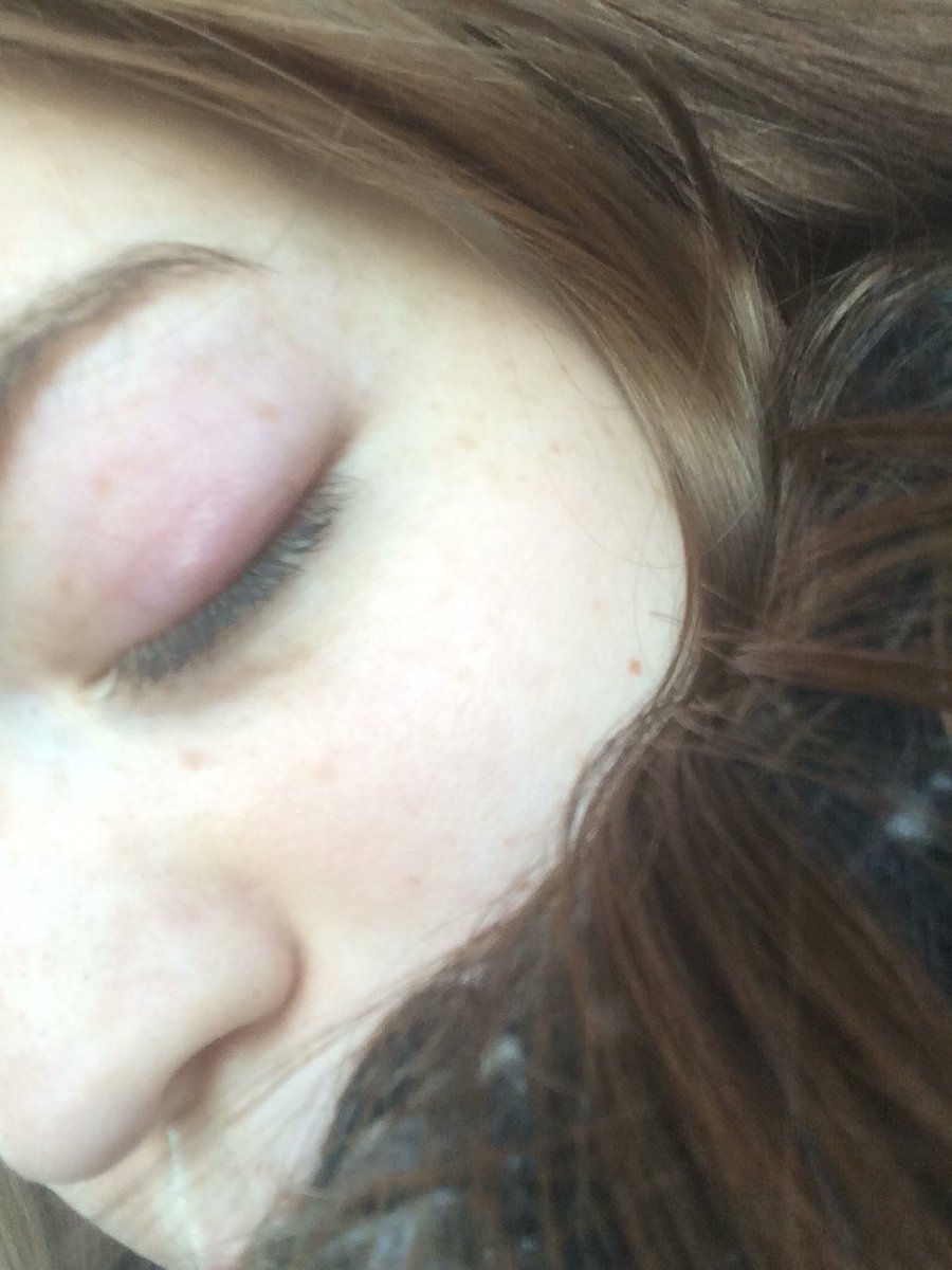 etdemma_'s tweet photo. So i’ve got a eye infection and it hurts pretty bad and it looks like shit. https://t.co/0nU8yvdS9u
