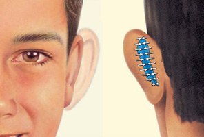 Otoplastia, la cirugía que dice adiós a las “orejas de soplillo”
goo.gl/fmMXju