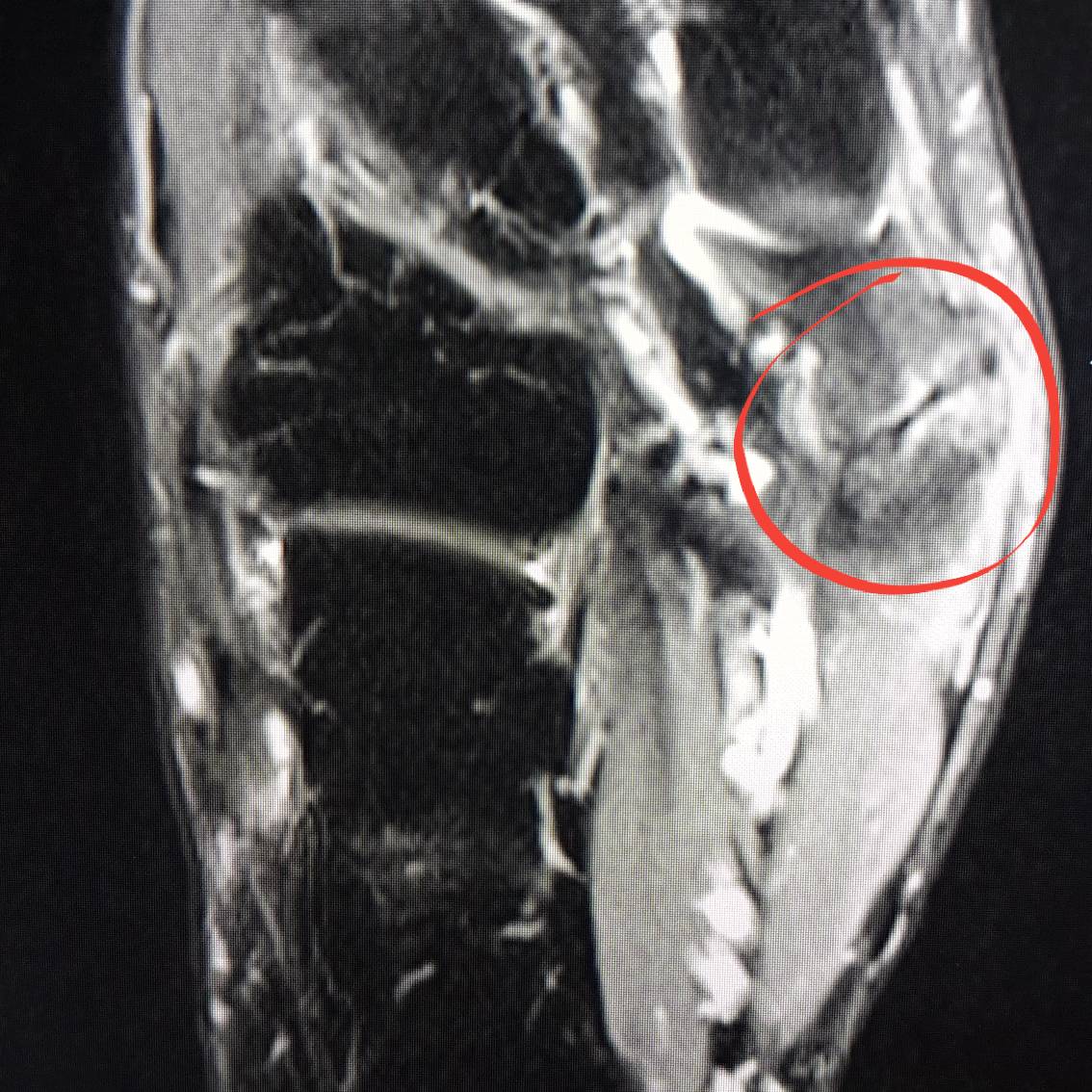 gordonortho's tweet photo. #accessorynavicular is a prominence of bone in the medial mid foot. This can be painful. Treatment is using an #orthotic and guided injections https://t.co/yZvc8Jlexl