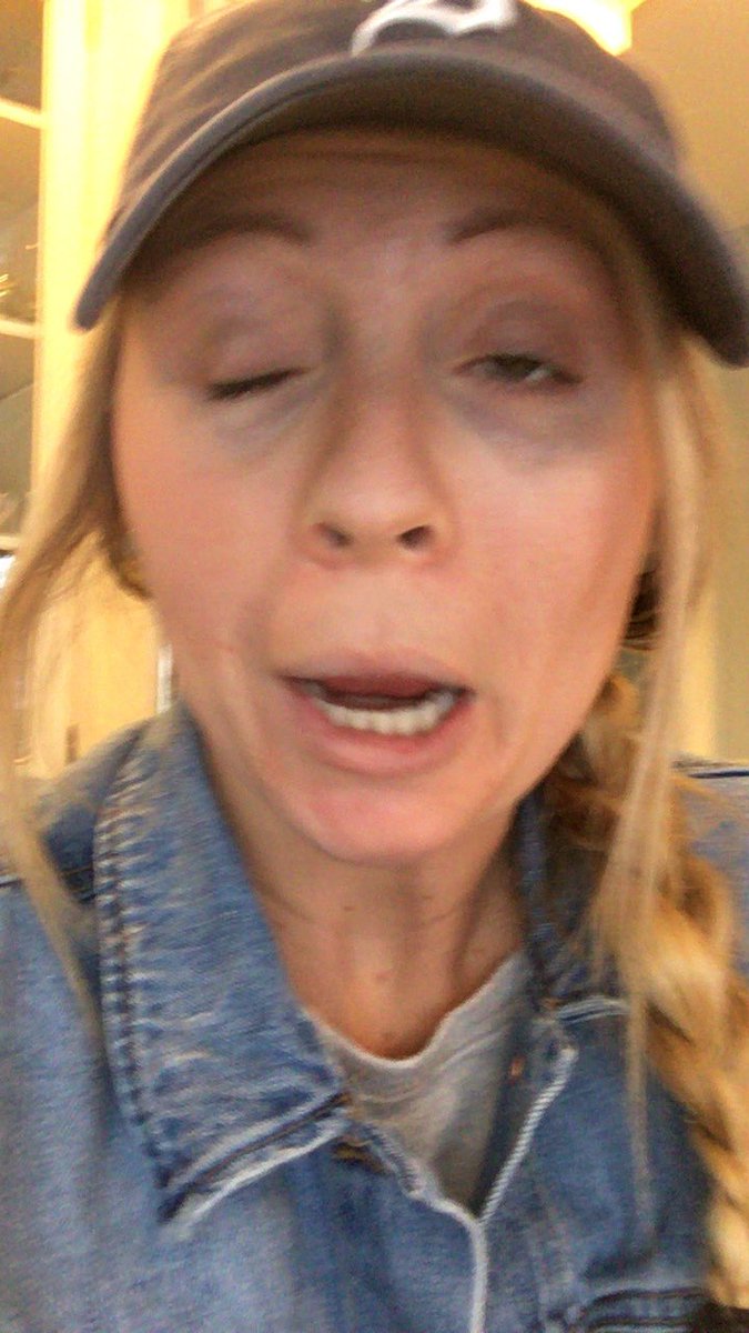 b_krisp05's tweet photo. This girl thought it would be cool to smoke alcohols and now she looks like this. Think before you try to be cool and smoke alcohols. 😅 https://t.co/wZPPzTj70u