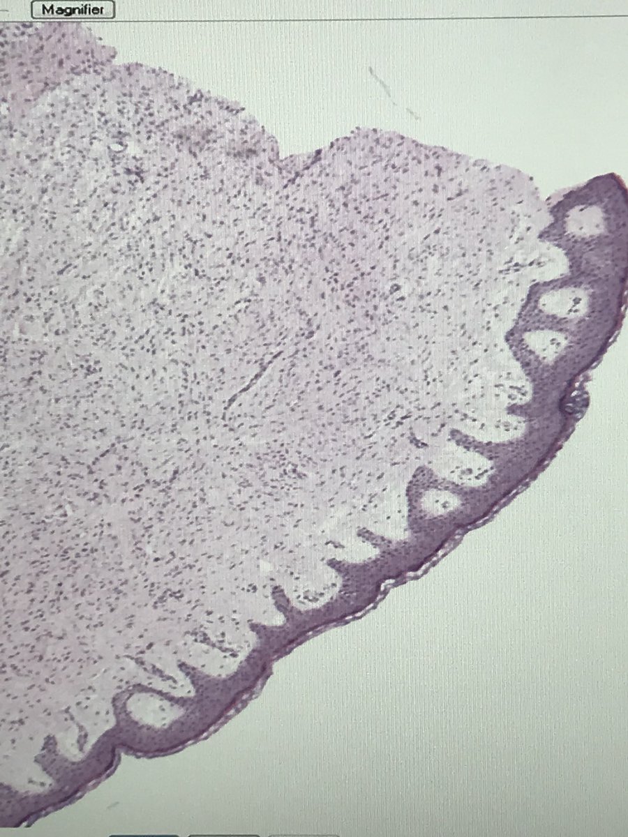 USFDermpath's tweet photo. Plaque from the thigh of a 50 year—smells like neurofibroma but CD34 positive:beware the DFSP with deceptively low-grade cytology! https://t.co/hzUtny1HOm