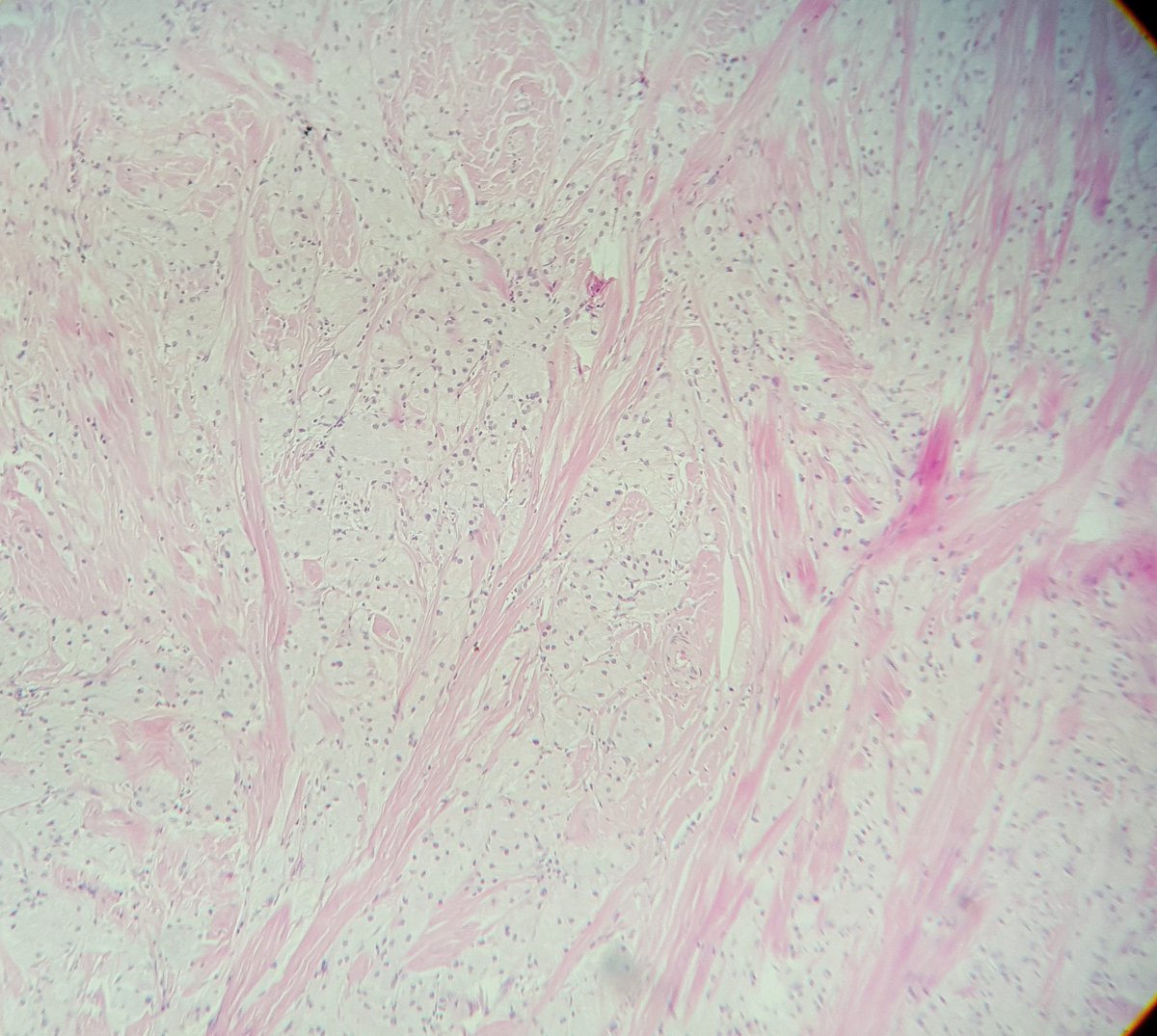 jov_rada's tweet photo. Vulvar granular cell tumor, detail, HE stain
#pathology #ginpath https://t.co/lC3a7gKRBP