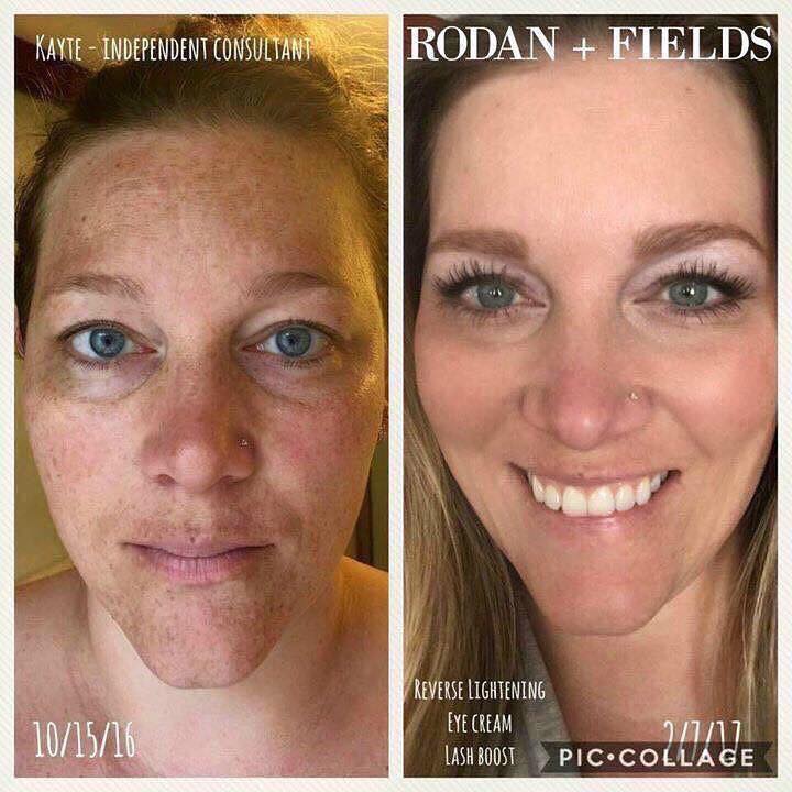 Rodanrodannadan's tweet photo. @abstroIogy @chellychelle If you two are trying to clear up melasma, Reverse is AMAZING!!
Check out my profile and if you are interested in learning more, I'd love to help! https://t.co/4Ij9t5lItE