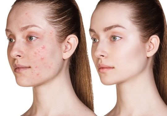 KitchenPanacea's tweet image. Skin care remigen for the treatment of #face scars, for free #acne treatment find here: goo.gl/ybhsuW
#AcneTreatment
#SkinCare
#SkinCareRoutine
#HomeRemedies
#KitchenPanacea