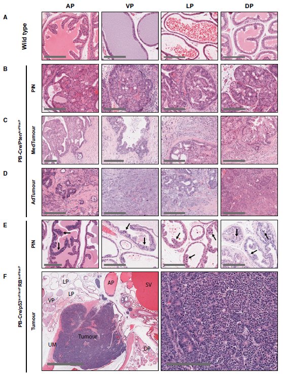 LambAlastair's tweet image. Detailed analysis of #TransgenicModels from @CRUKCambridge gives important insights into development of #ProstateCancer highlighting potential #TherapeuticTargets.
#MELK offers exciting potential-predicts relapse &amp;amp; MELKi #OTS167 stops mitosis.
@EmboMolMed 
embomolmed.embopress.org/content/early/…