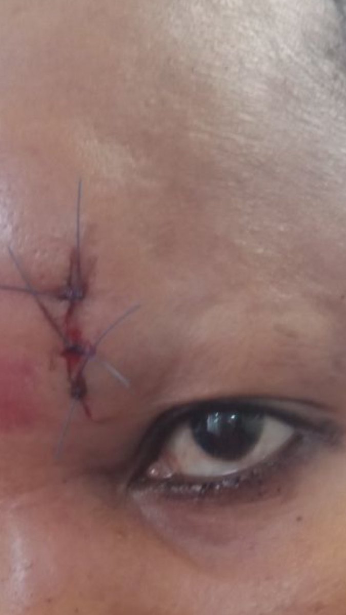 Najmmer's tweet photo. Her husband has also been Psychologically torturing her telling her she comes from a poor background and cannot survive without him. He says she has no voice in society and therefore can never escape his grip. 
#EndDomesticViolence
@DrMercyKorir @Gvrckenya @AllWomanktn @KTNNews https://t.co/LKvVXYhroz