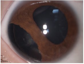 OphthaTweets's tweet photo. Airsoft gun-related ocular injuries: long-term follow-up https://t.co/eyhuA9DWg6 via #JAAPOS https://t.co/Jp4nhNSvjd