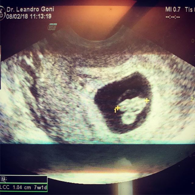 Eduardo Vaccaro Coming Soon Septiembre 18 Baby Bebe Eco Mama Papa Embarazada Pregnant 7semanas 7weeks T Co Vrli6oqsrd T Co Miv94p07c7 Eduardo Vaccaro Coming Soon Septiembre 18 Baby Bebe Eco Mama Papa Embarazada Pregnant 7semanas 7weeks T Co Vrli6oqsrd T Co Miv94p07c7