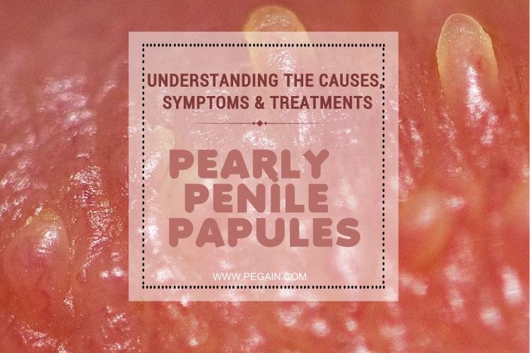 Do You Have This In Your #Penis? buff.ly/2EPjyky #pearlypenilepapules #pearlypapulesremovals #health #healthtips #penisdisease #Menshealth #menshealthua #genitalwarts #warts #wartsremoval #pearlypenilepapulesremoval #pearlypenileremoval