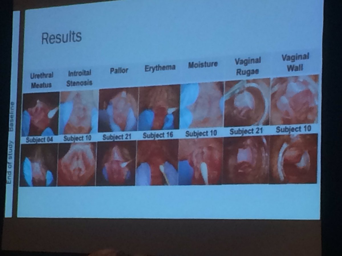 <a href="/SDSexualMed/">San Diego Sexual Med</a> and my mentor Sue Goldstein shows that ospemiphene objectively improves #vulvar tissue when treating #menopause. #GSM #isswsh2018
