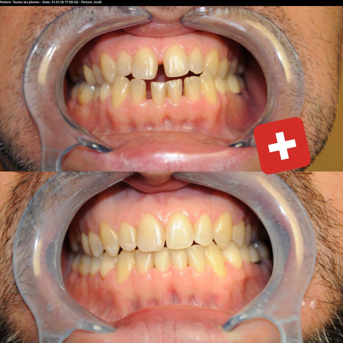 dentistescabri's tweet photo. 7 mois de traitements. #fastbraces #Dentist #lausanne #Repost #picoftheday #cabri #benoitcabri #Switzerland #swiss #suisse #callonus https://t.co/8fKFNJj4Wj