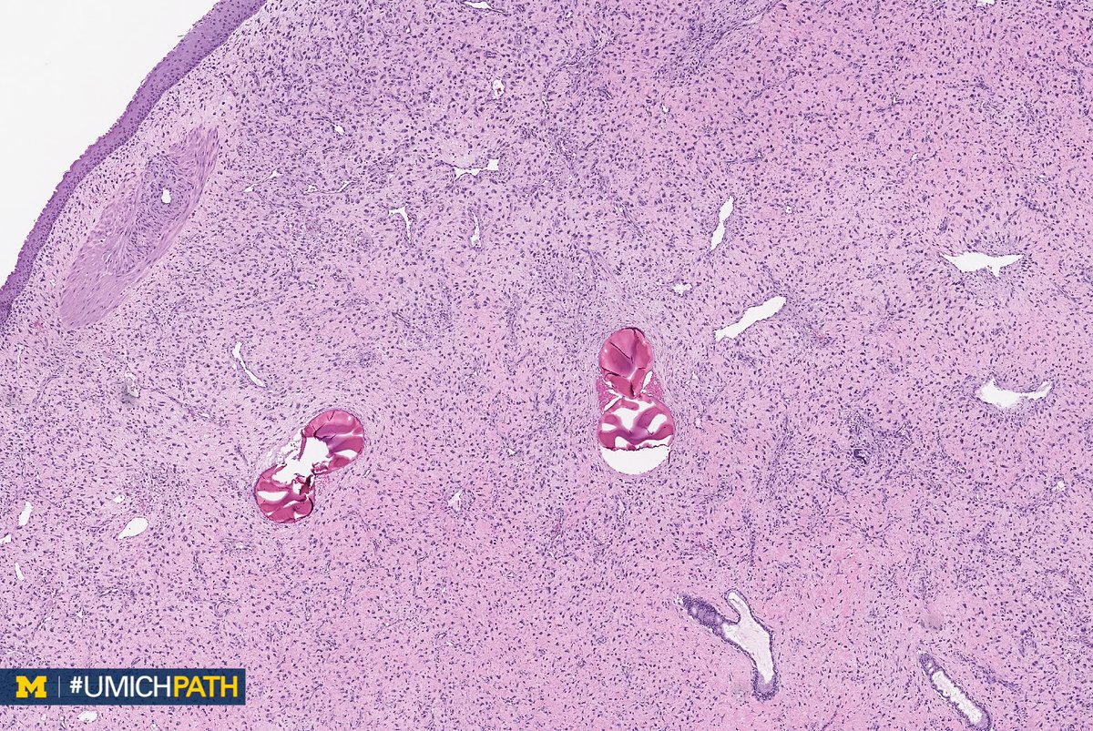 UMichPath's tweet photo. A: Nasopharyngeal angiofibroma. Benign, exclusively in males (usually teens); Testerone-dependent. Treatment: Endoscopic resection after embolization. Histo: Submucosal fibrous stromal proliferation of angular/stellate cells w/ variably-sized staghorn vessels #DailyDx #ENTPath https://t.co/sW52BP6L2G