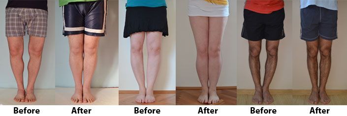 pegain123's tweet photo. #REVIEW: Do Bow Legs No More Fix Knock Knees? https://t.co/BZImeftEOh #bowlegs #bowlegsnomore #bowlegsnowmorereviews #knockknees #bowlegssolution #knockkneessolutoin https://t.co/TcciUQryRE