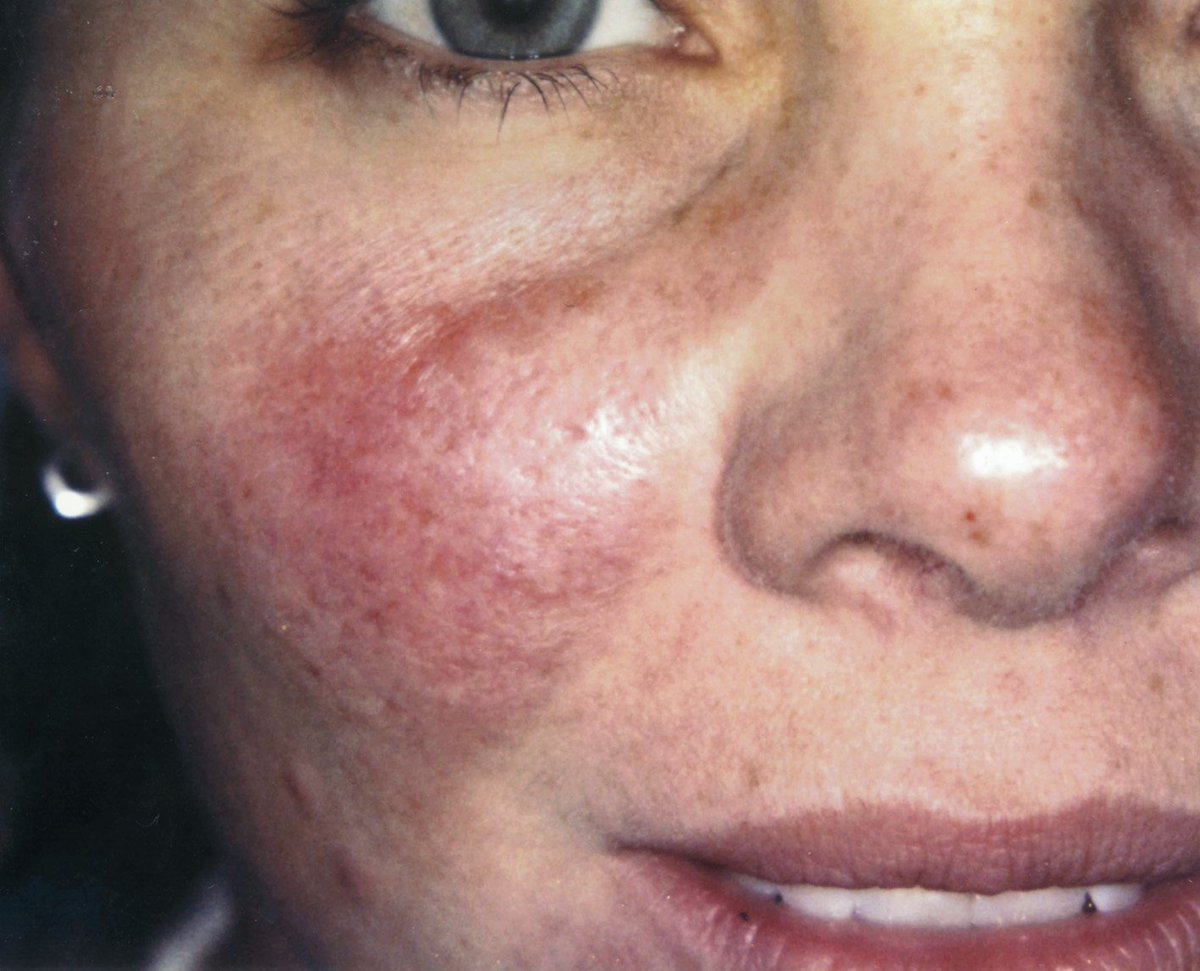 murad rosacea